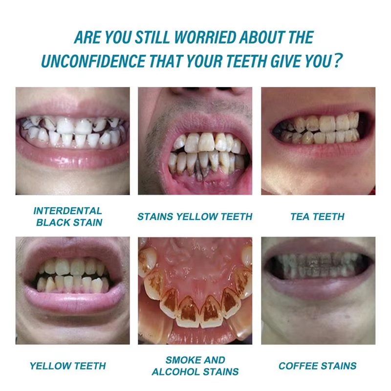 치아 미백 에센스 플라크 얼룩 제거 세럼 신선한 호흡  - Teeth Whitening Serum 리뷰 및 가격