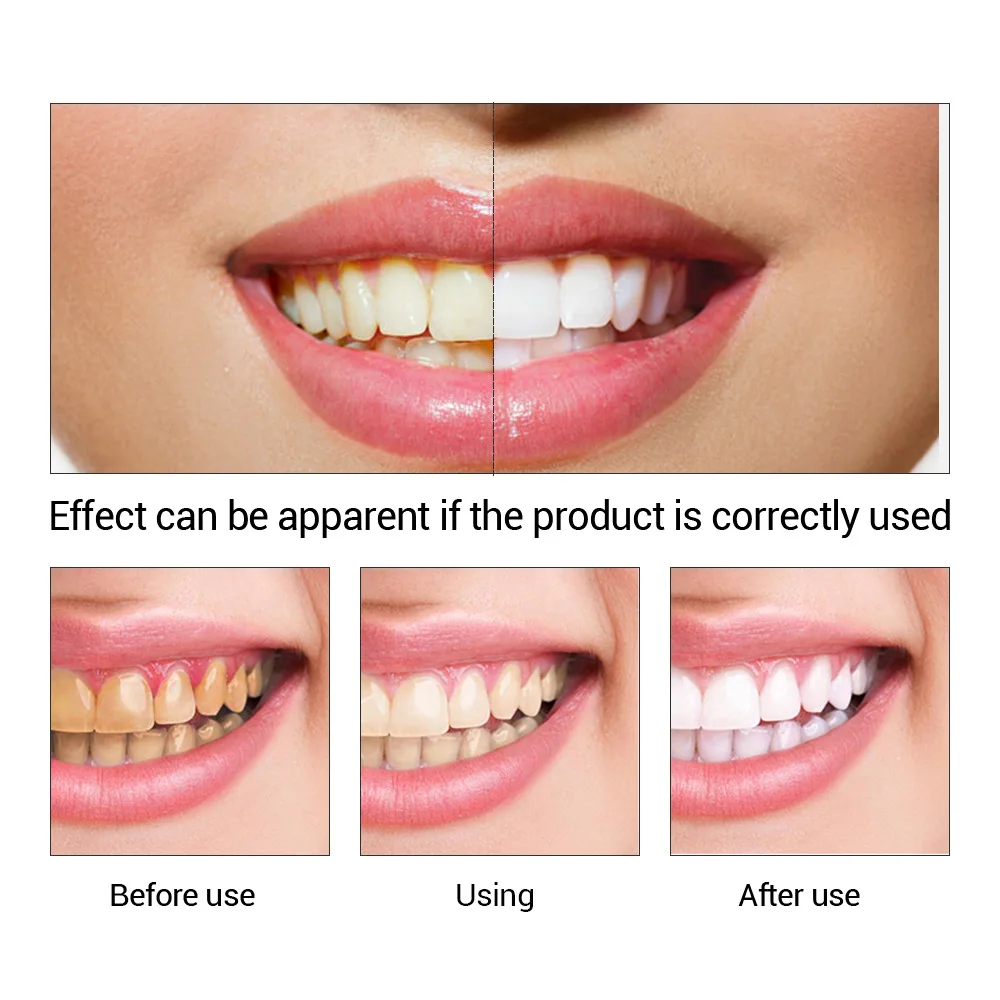 FTEENPLY 치아 미백 에센스 파우더 구강 위생 청 - Teeth Whitening Serum 리뷰 및 가격