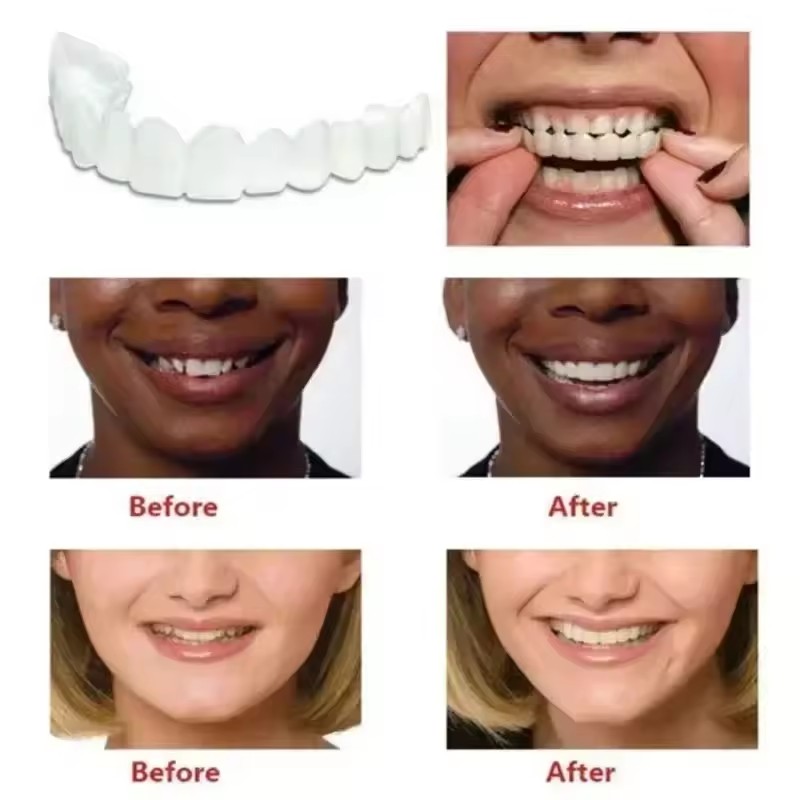 치아 베니어 화이트닝 틀니 교정기 임시 가짜 치아 커버 - Teeth Whitening Vape 리뷰 및 가격