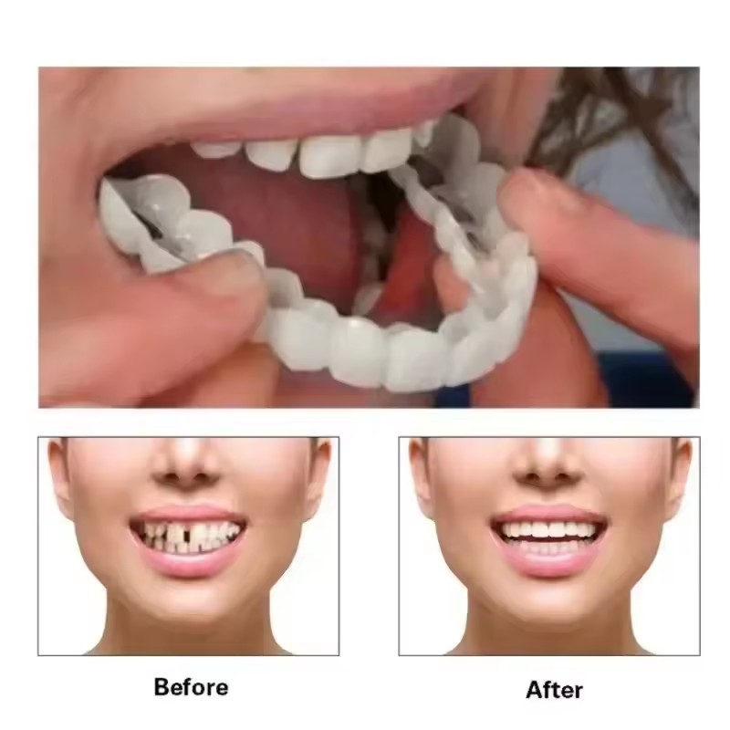 치아 베니어 화이트닝 틀니 교정기 임시 가짜 치아 커버 - Teeth Whitening Vape 리뷰 및 가격