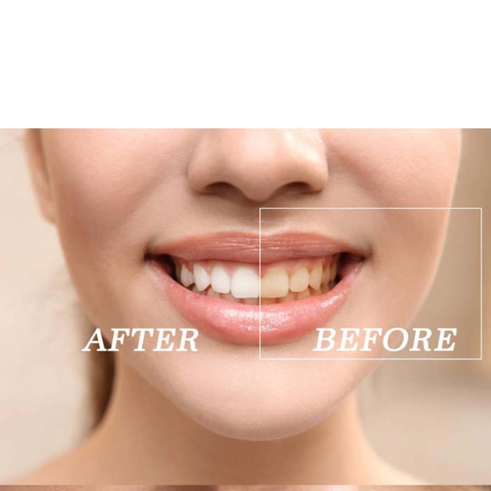 최고 품질의 과산화물 치아 미백 젤 키트 표백 시스템  - Teeth Whitening Gel Peroxide 리뷰 및 가격
