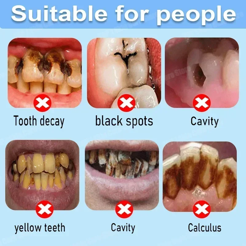 충치 방지 치약은 충치를 복구하고, 충치를 제거하며,  - Teeth Whitening Foam 리뷰 및 가격