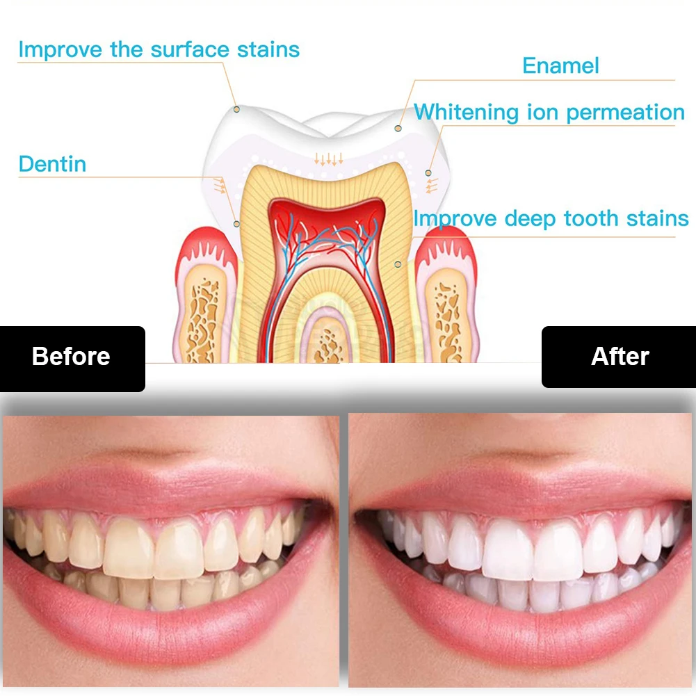 치과 치아 미백 키트 미니 16 LED 콜드 라이트 3 - Teeth Whitening Near Me 리뷰 및 가격